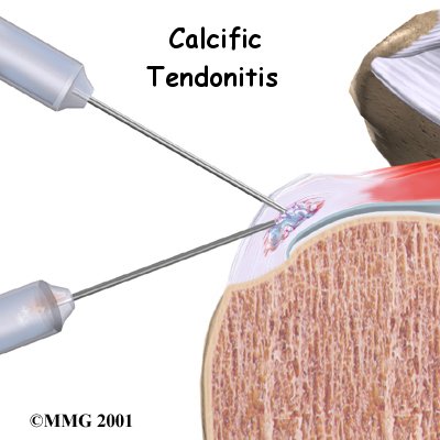 Calcific Tendonitis of the Shoulder