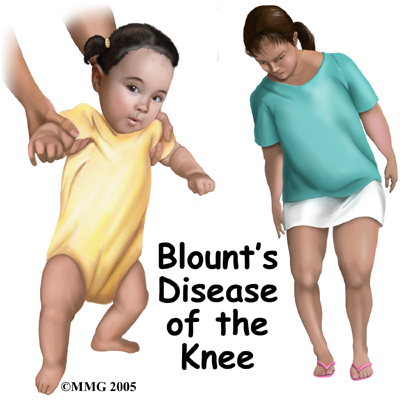 Blounts Disease in Children and Adolescents
