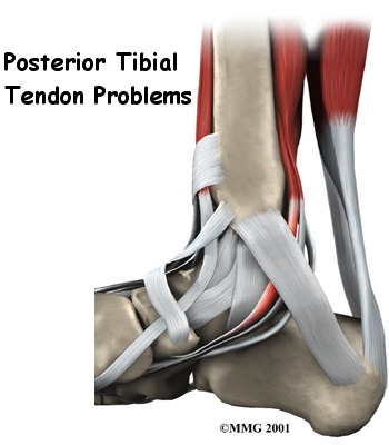 Posterior Tibial Tendon Problems Patient Guide