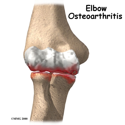 Osteoarthritis of the Elbow