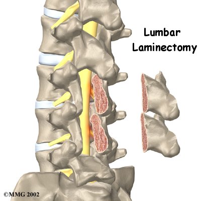 Lumbar Laminectomy